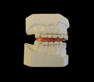 Appareil dentaire d’expansion