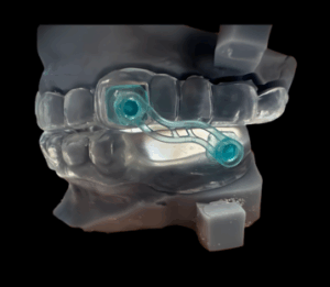 Appareil dentaire d’expansion