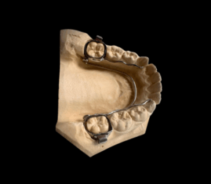 Appareil dentaire d’expansion
