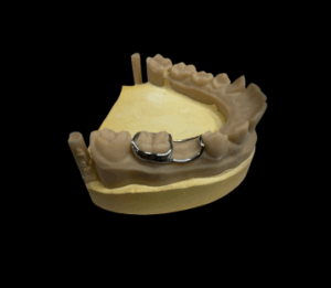 Appareil dentaire d’expansion
